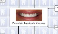Porcelain Laminate Veneers