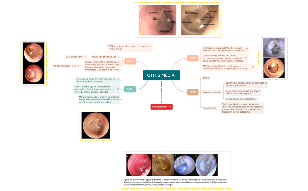 OTITIS MEDIA .xmind