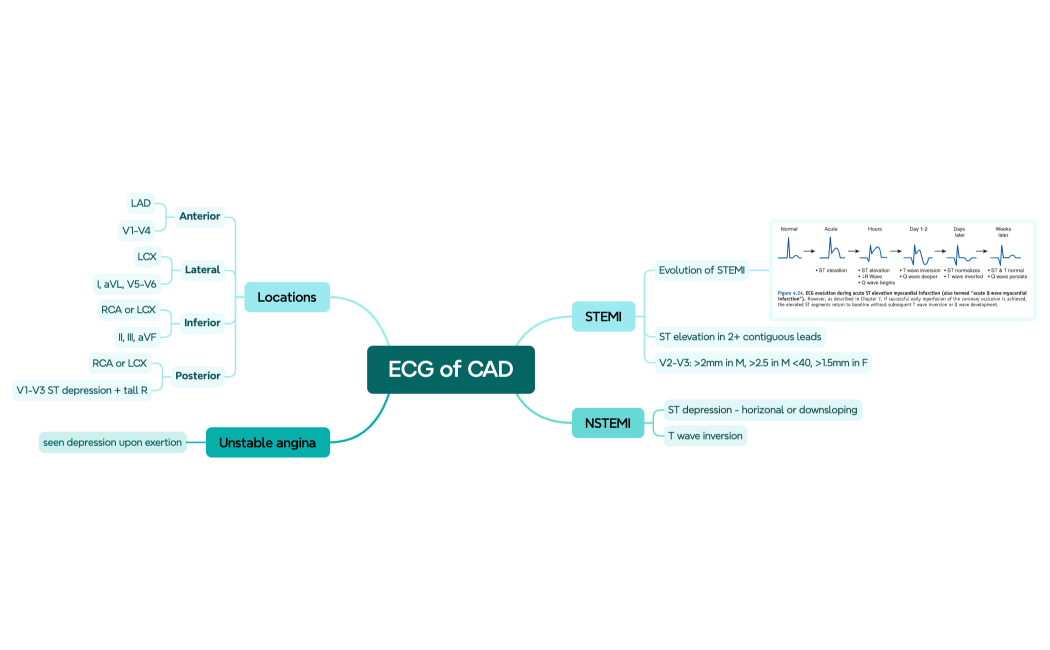 ECG of CAD