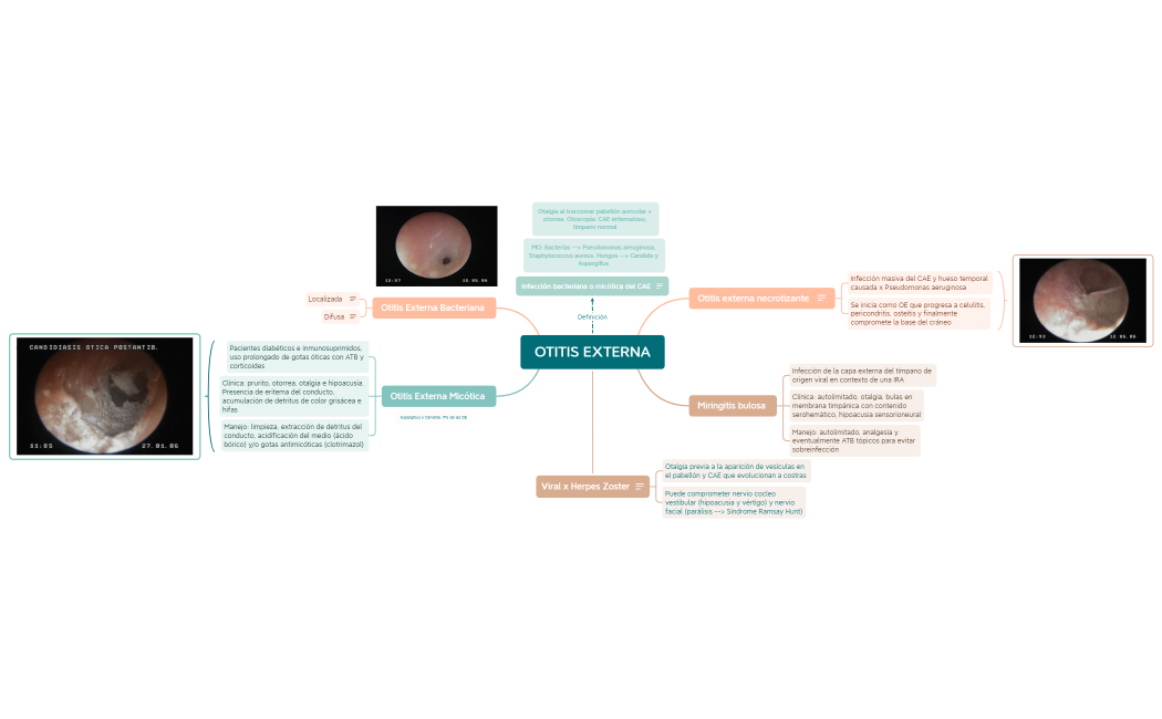 OTITIS EXTERNA.xmind